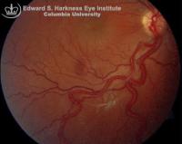 Prominent, dilated retinal feeding and draining (afferent and efferent) vessels extend all the way to the disc.